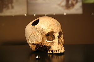 Crâne de jeune fille trépané au silex, 3500 av J-C